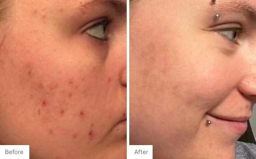 8 - Before and After Real Results photo of a woman's use of Neora's Acne Complexion Treatment Pads