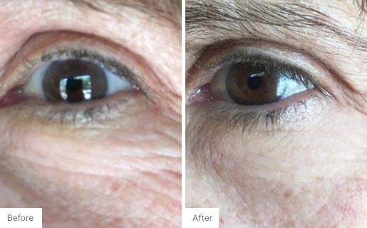8 - Before and After Real Results photo of a woman's eye area.
